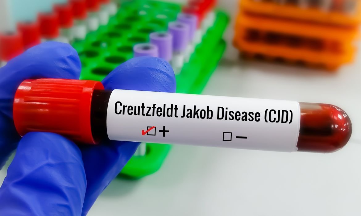 Creutzfeldt-Jakob: sintomas motores e visuais