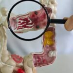 Brasil registra forte aumento de doença de Crohn e retocolite