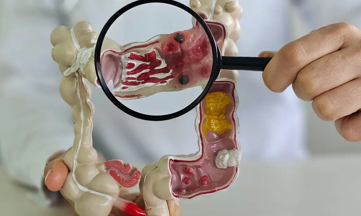Brasil registra forte aumento de doença de Crohn e retocolite